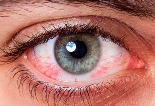 ojo seco
