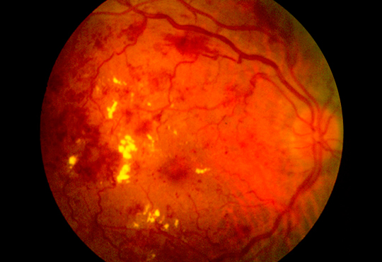 retinopatia diabetica