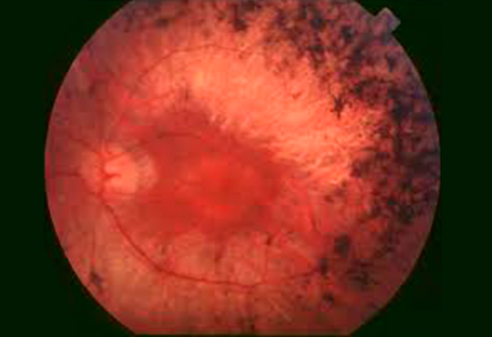 retinosis pigmentaria